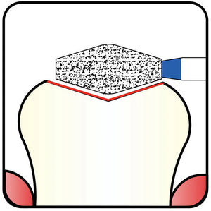 Precision, Redefined: Choosing Between 3.3 mm and 3.5 mm Double Conical Diamond Burs