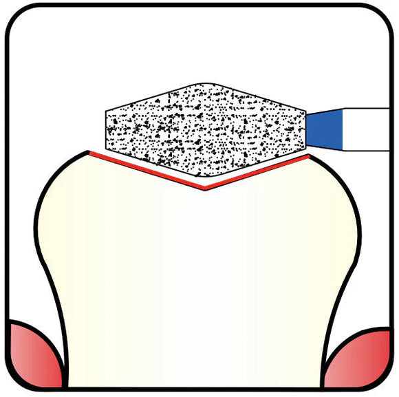Precision, Redefined: Choosing Between 3.3 mm and 3.5 mm Double Conical Diamond Burs