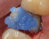 EtchRite Jumbo Refill 25ml. Syringe 2/pk. - Pulpdent - Osung USA