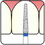 Torpedo, Conical 1.8 mm Dia. Medium Grit Diamond Bur 5 per pack. 294.18M1 - Osung USA