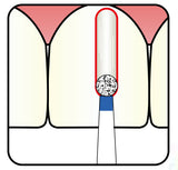 Spherical 1.4 mm Dia. Medium Grit Diamond Bur 5 per pack. 001.14M1 - Osung USA