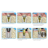 Osung Dental Screw Removal Kit -OSR-KIT - Osung USA