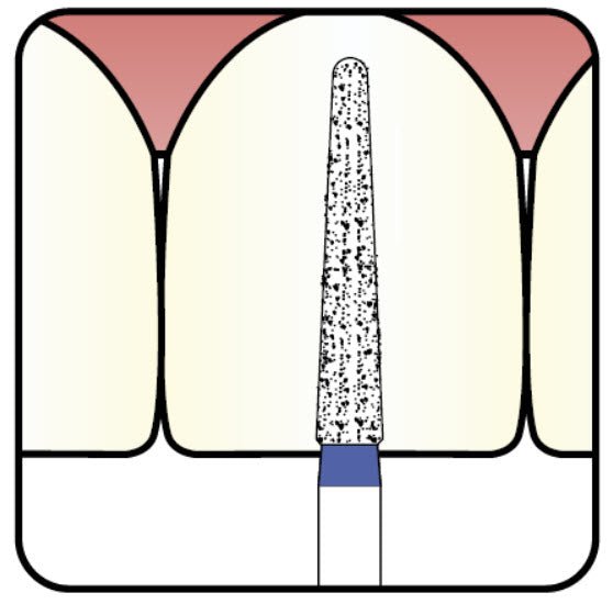 thumbnail image 2 of Conical, Dome End 1.8 Mm Dia. Extra Coarse Grit Diamond Bur 5 Per Pack. 194.18EC3 2 of 13